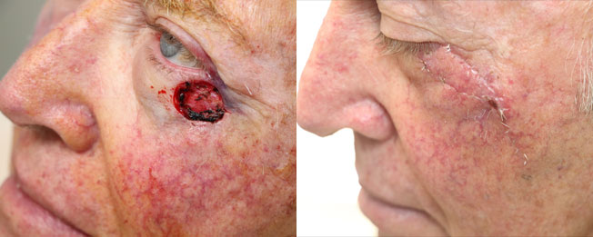 micrographic surgery before & after