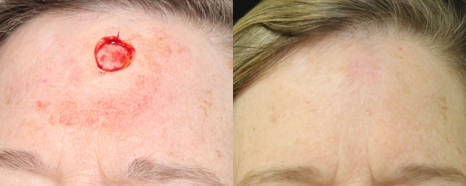 This pt Had Mohs micrographic surgery for basal cell carcinoma of the forehead. she’s very pleased with her postoperative result.