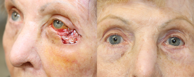 patient with a melanoma of the left lower eyelid