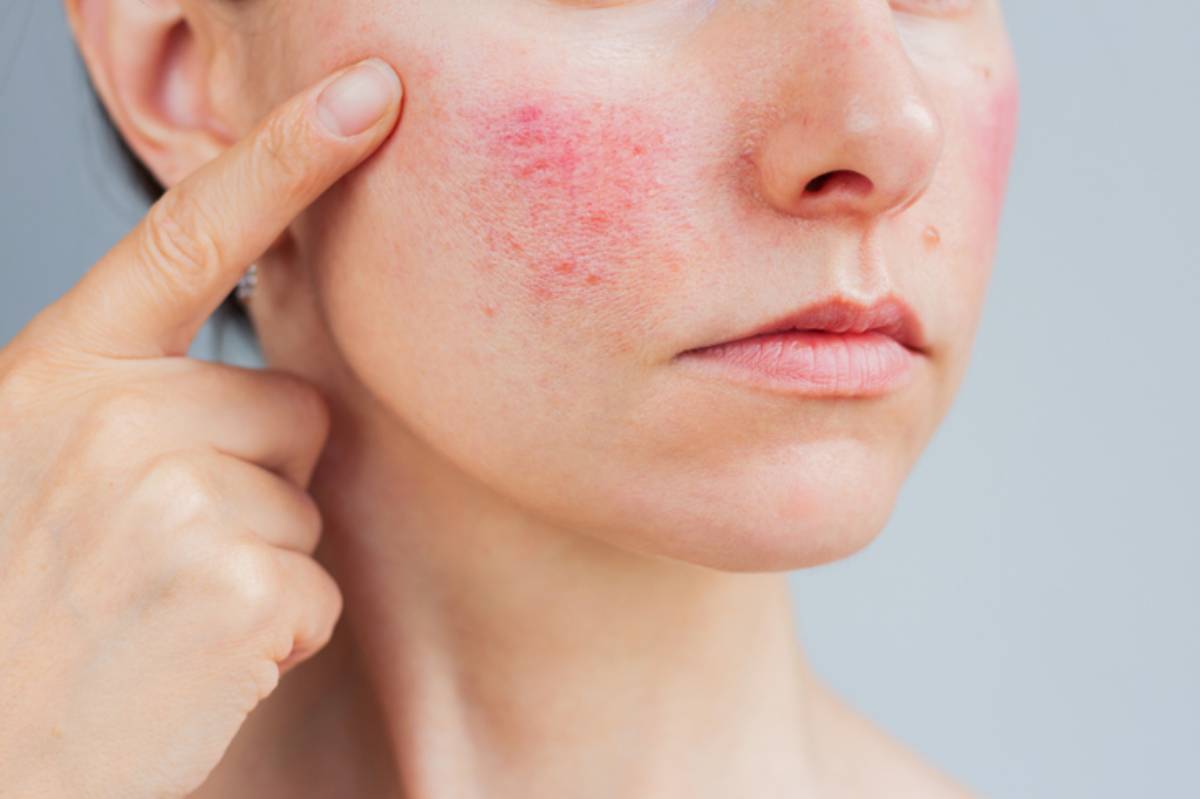 Woman suffering from rosacea on her face in the acute stage, she showing redness on her cheek.